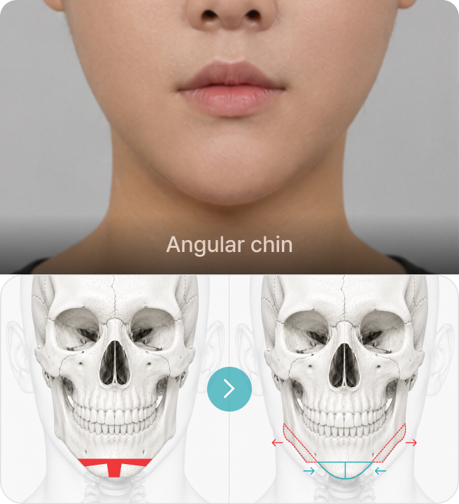 Angular chin