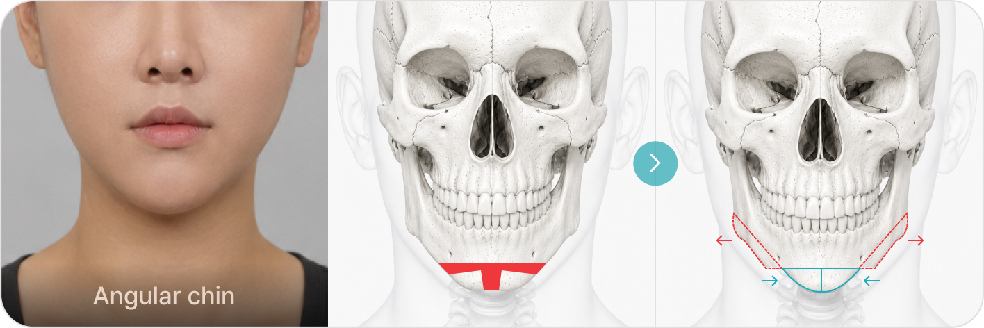 Angular chin