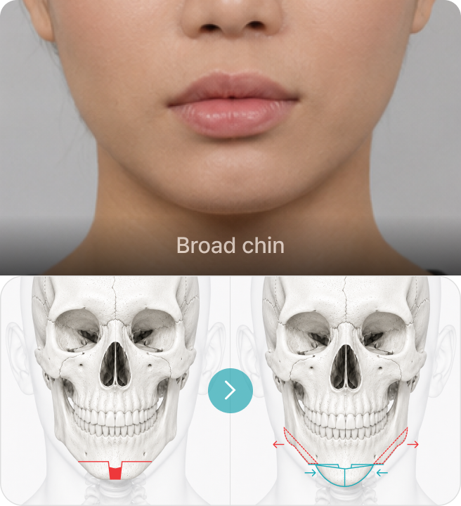 Broad chin