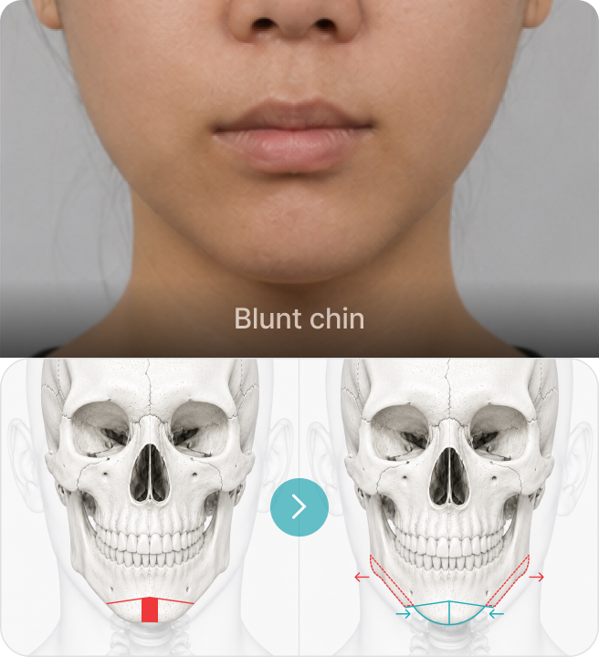 Blunt chin