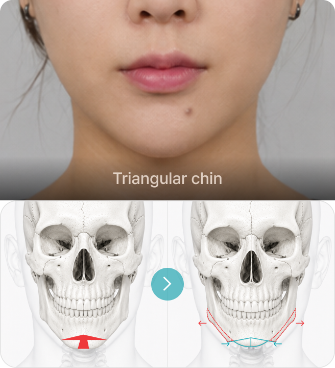 Irregular chin