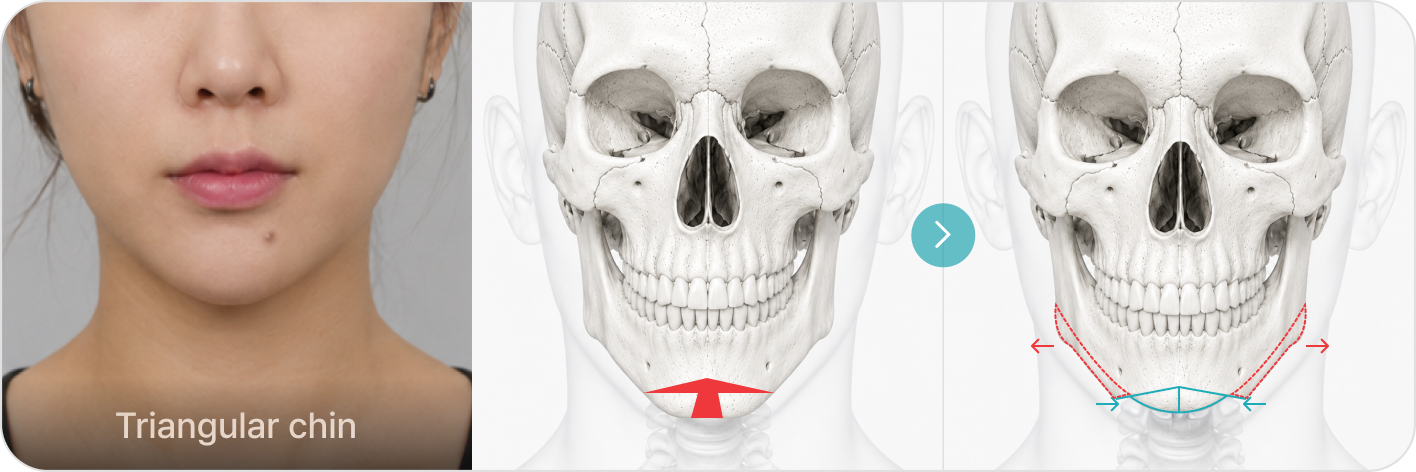 Irregular chin