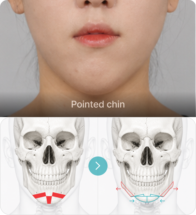 Pointed chin