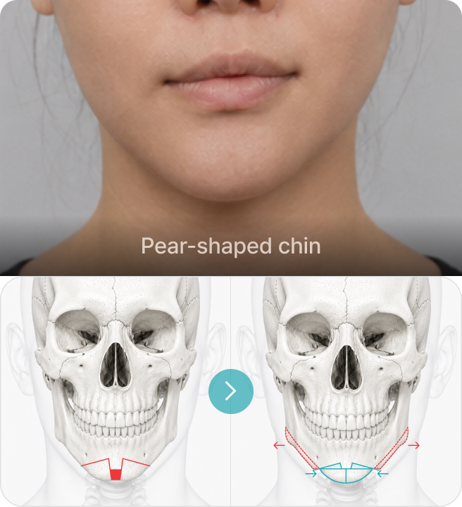 Pear-shaped chin