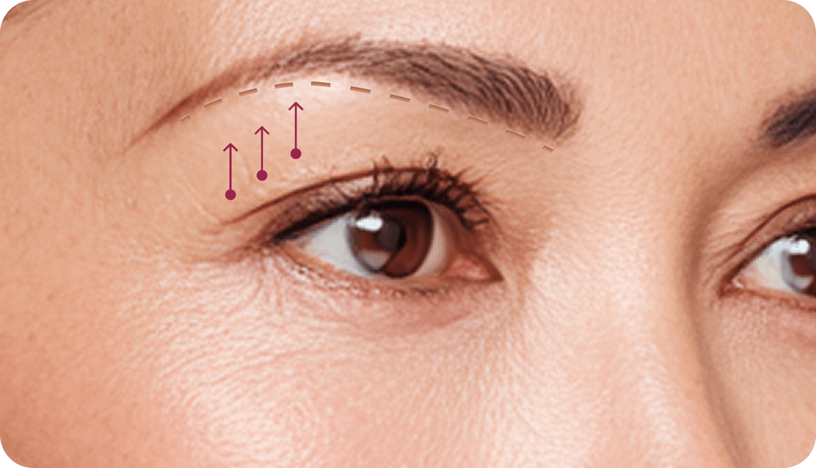 id Hospital - Browlift - After Surgery