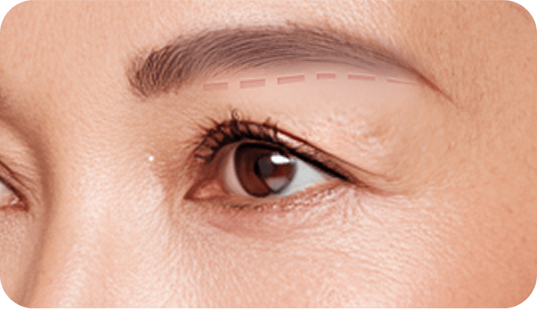 id Hospital - Browlift - Step 01 Incision Along Brow Line
