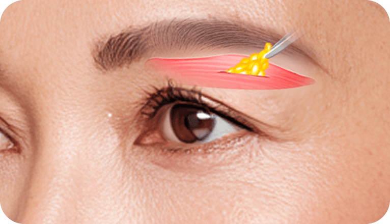 id Hospital - Browlift - Step 02 Removal of Sagging Skin