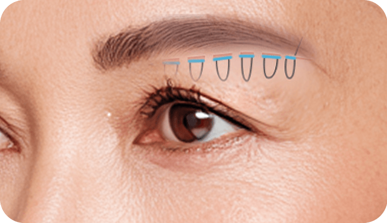id Hospital - Browlift - Step 03 Pulled Fixed and Sutured