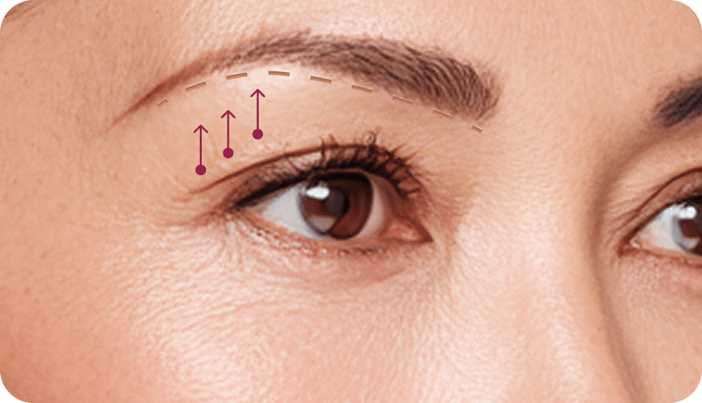 id Hospital - Browlift - 1 Month After Surgery
