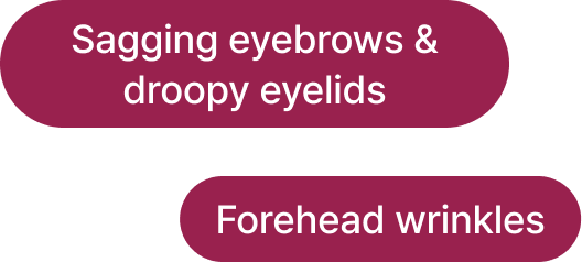 id Hospital - Endotine Forehead Lift - Sagging Eyebrows Droopy Eyelids Forehead Wrinkles