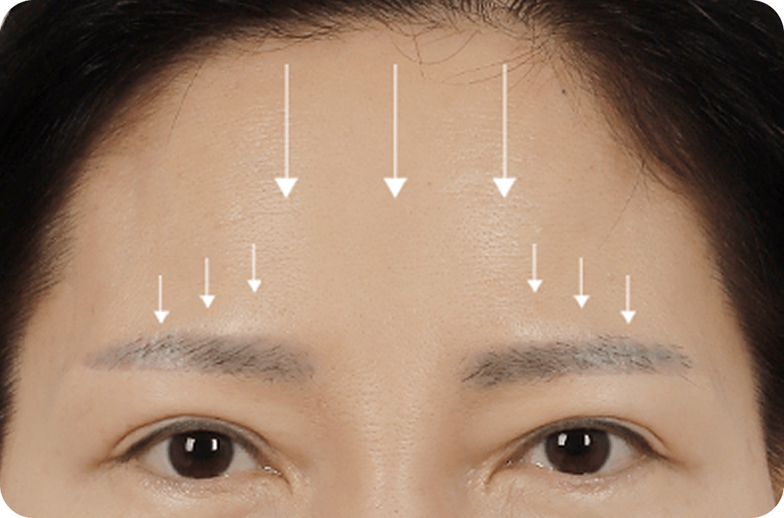 id Hospital - Endotine Forehead Lift - Before Surgery