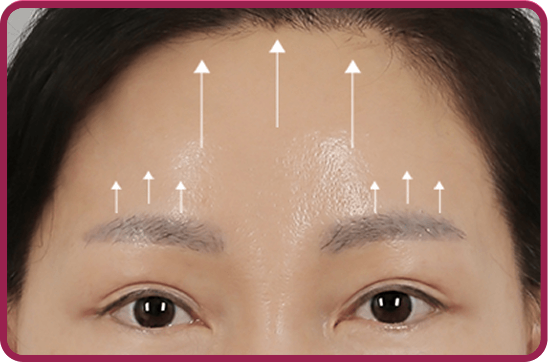 id Hospital - Endotine Forehead Lift - After Surgery