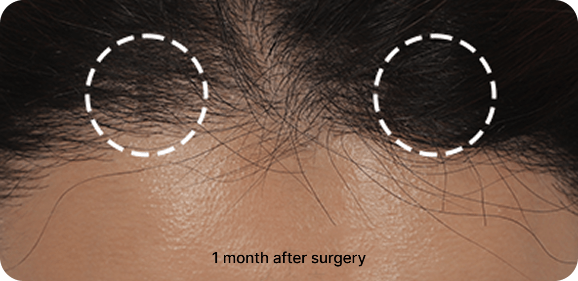 id Hospital - Endotine Forehead Lift - 1 Month After Surgery