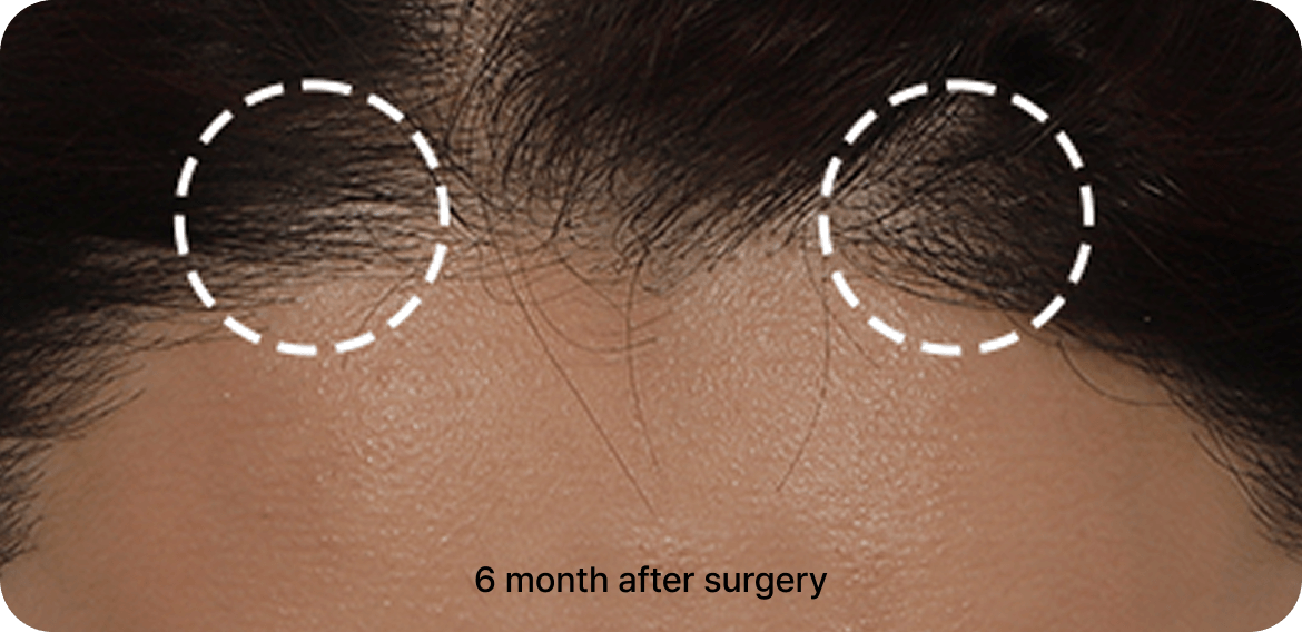 id Hospital - Endotine Forehead Lift - 6 Months After Surgery