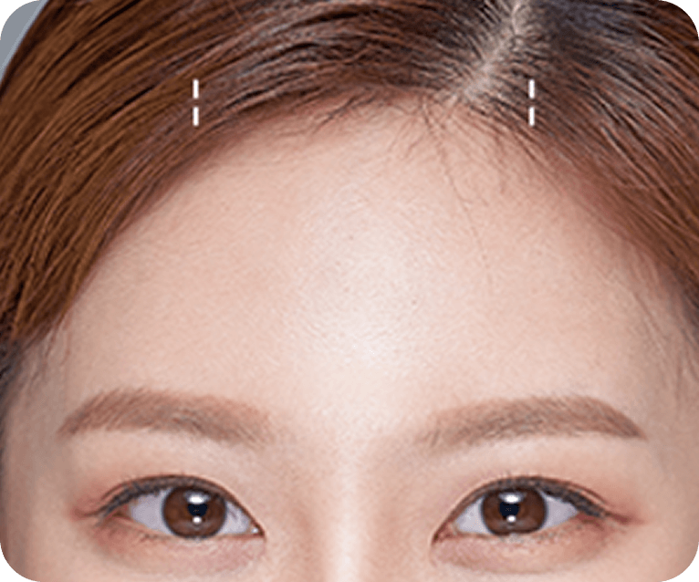 id Hospital - Endotine Forehead Lift - Surgical Method Step 01