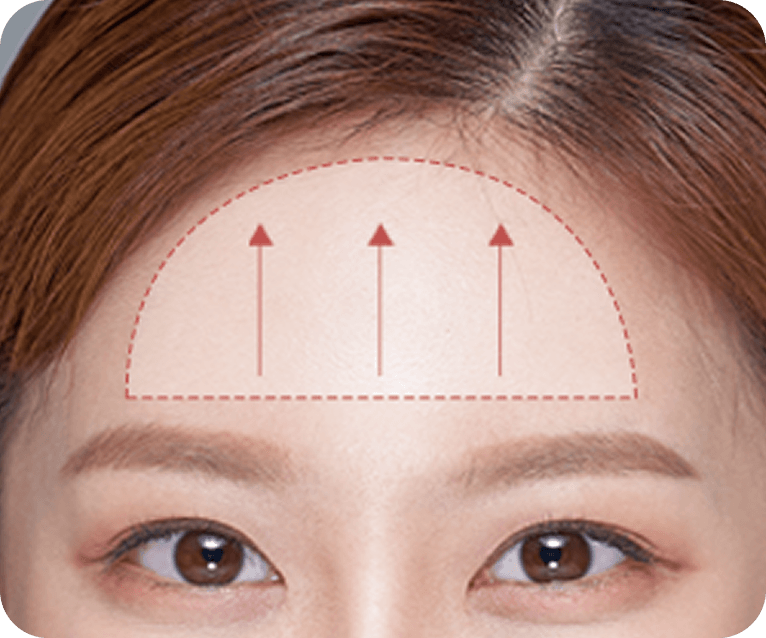 id Hospital - Endotine Forehead Lift - Surgical Method Step 02