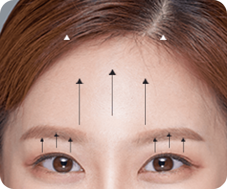 id Hospital - Endotine Forehead Lift - Surgical Method Step 03