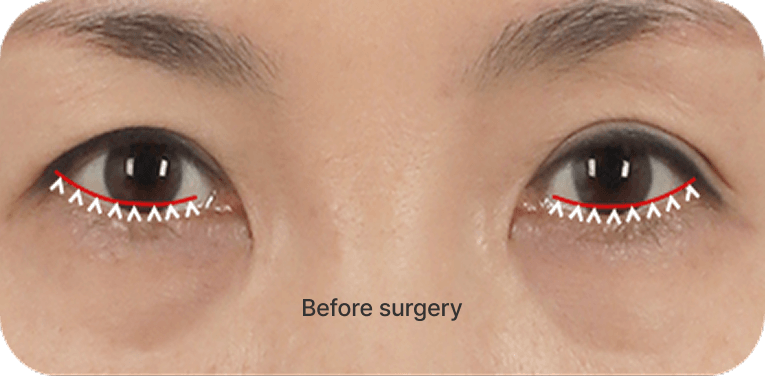 id Hospital - Lower Blepharoplasty - Micro-Incision Middle-Aged Eye Surgery Step 01