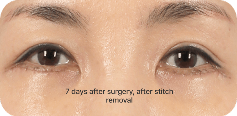 id Hospital - Lower Blepharoplasty - Micro-Incision Middle-Aged Eye Surgery Step 02