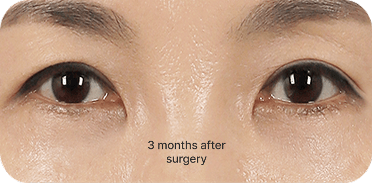 id Hospital - Lower Blepharoplasty - Micro-Incision Middle-Aged Eye Surgery Step 03
