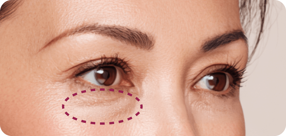 id Hospital - Lower Blepharoplasty - Before Surgery