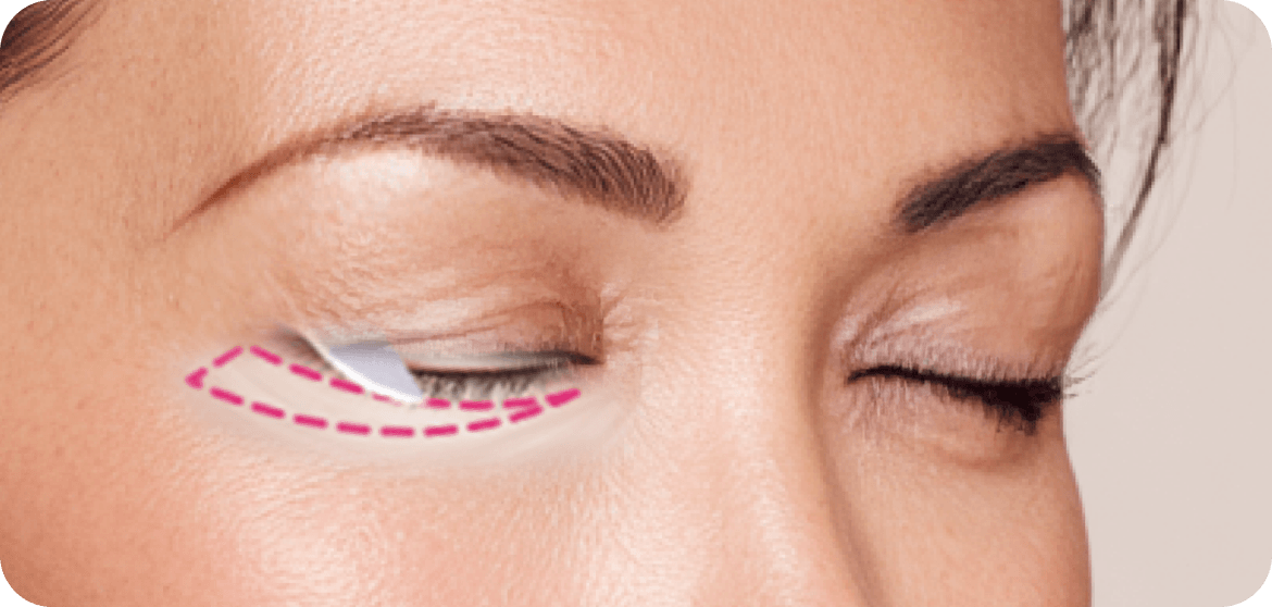id Hospital - Lower Blepharoplasty - Sagging Skin Removal