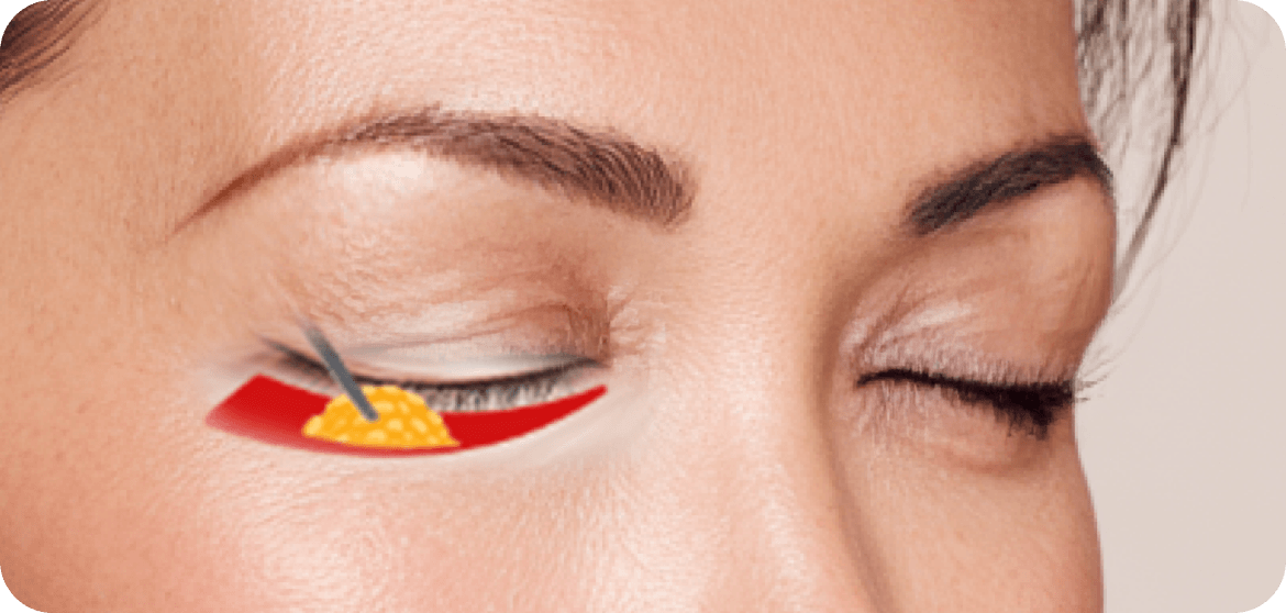 id Hospital - Lower Blepharoplasty - Eyelid Muscle Strengthening
