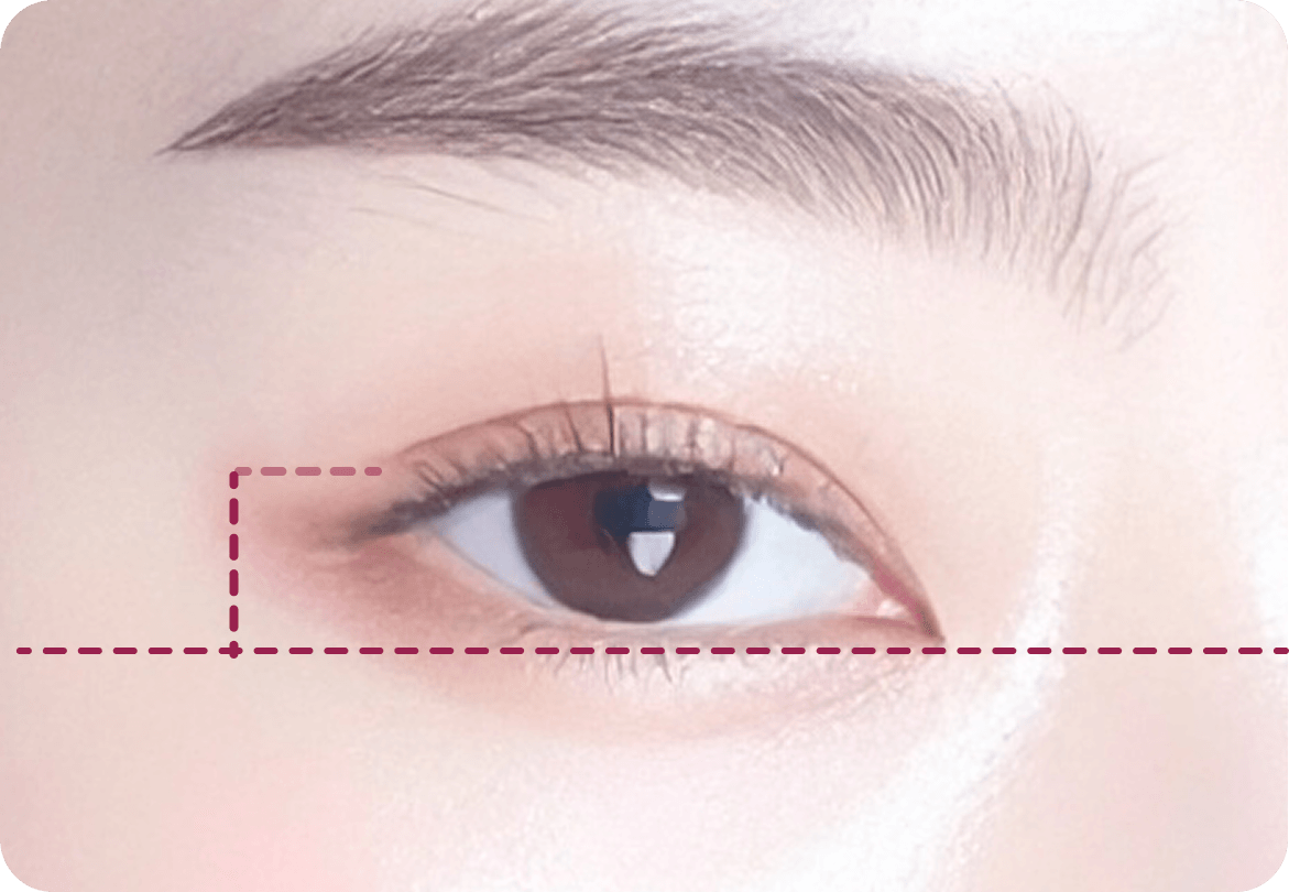 id Hospital - Middle-Age Ptosis Correction - Sleepy-looking Eyes Less than 70 Percent Iris Exposed
