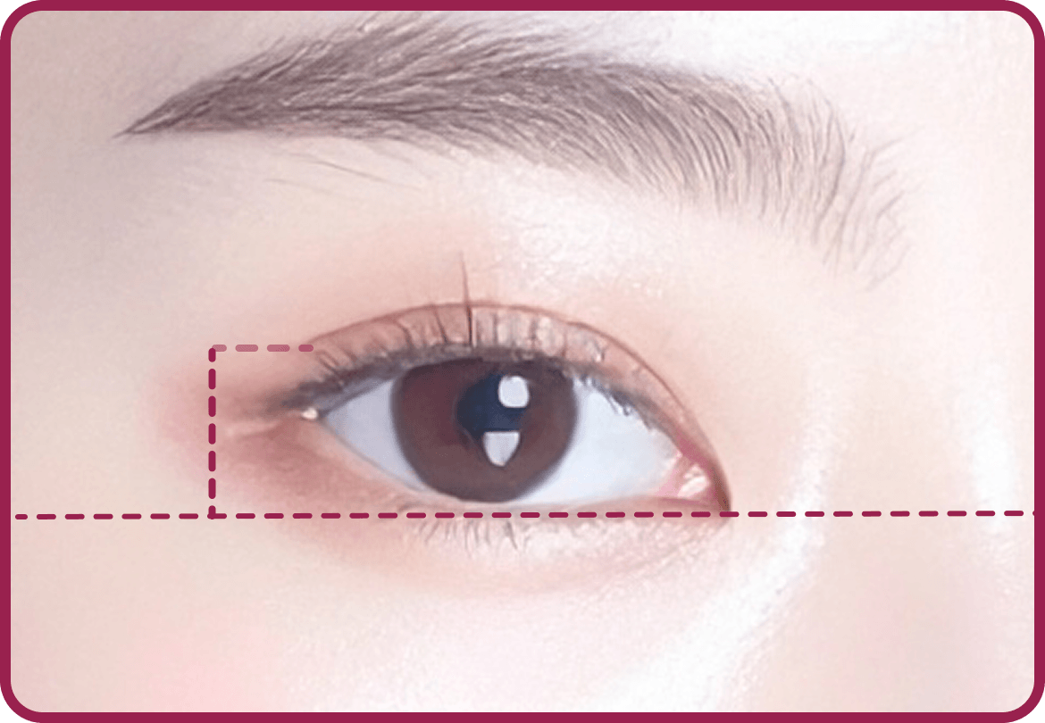 id Hospital - Middle-Age Ptosis Correction - Normal Eyes 80 to 90 Percent Iris Exposed