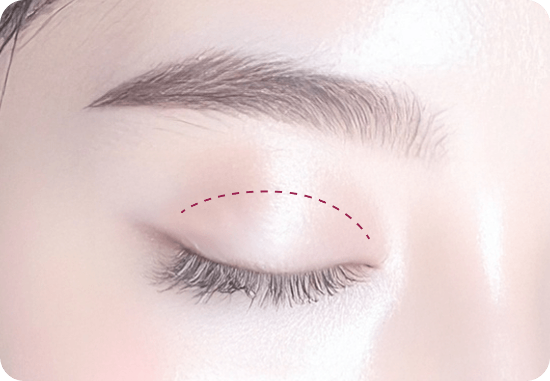 id Hospital - Middle-Age Ptosis Correction - Non-incisional Eye Shape Correction