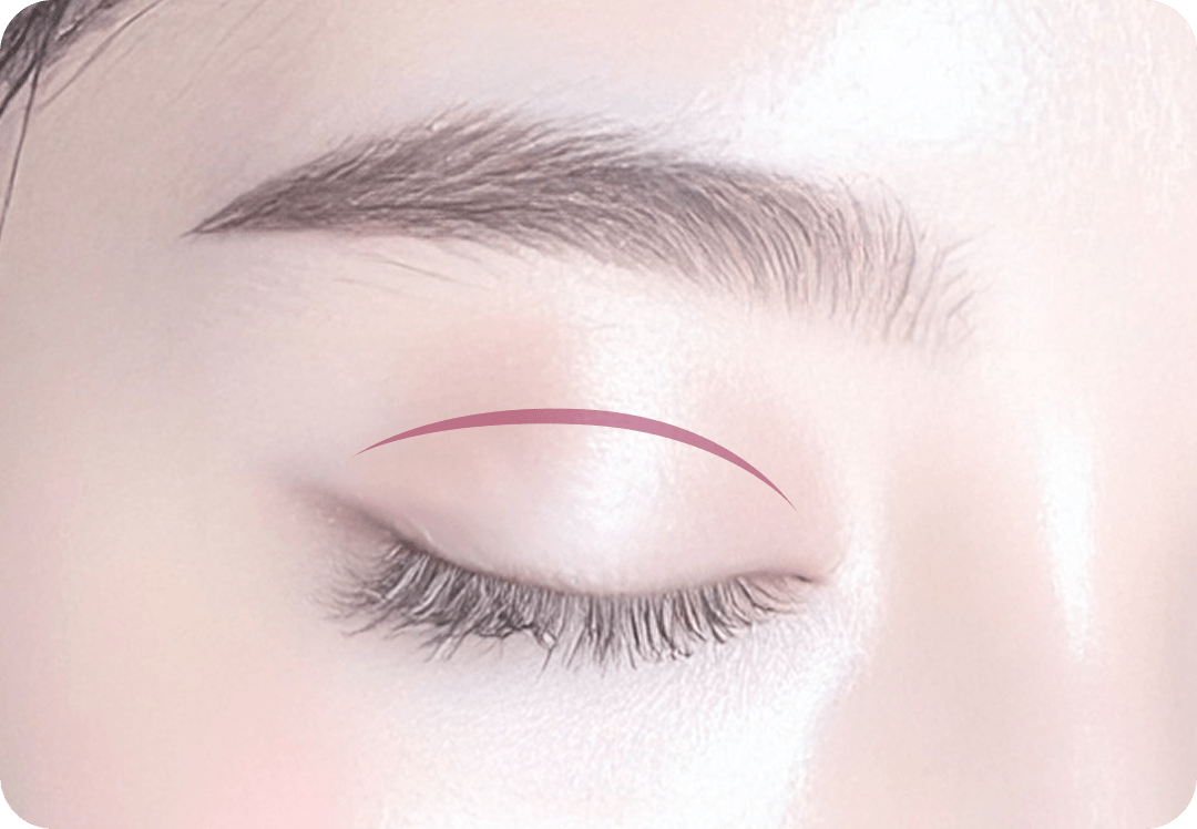 id Hospital - Middle-Age Ptosis Correction - Incisional Eye Shape Correction