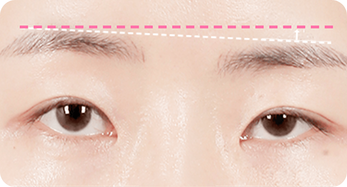 id Hospital - Middle-Age Ptosis Correction - Control Eye Shape Correction Before Surgery