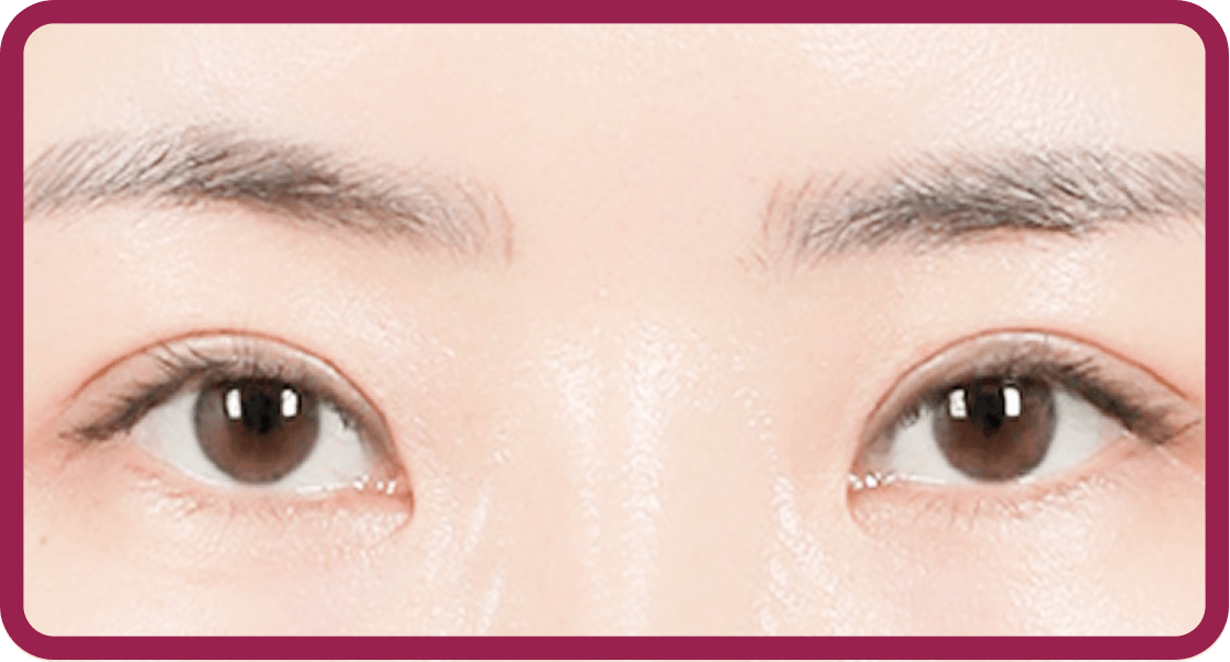id Hospital - Middle-Age Ptosis Correction - Control Eye Shape Correction 1 Month After Surgery