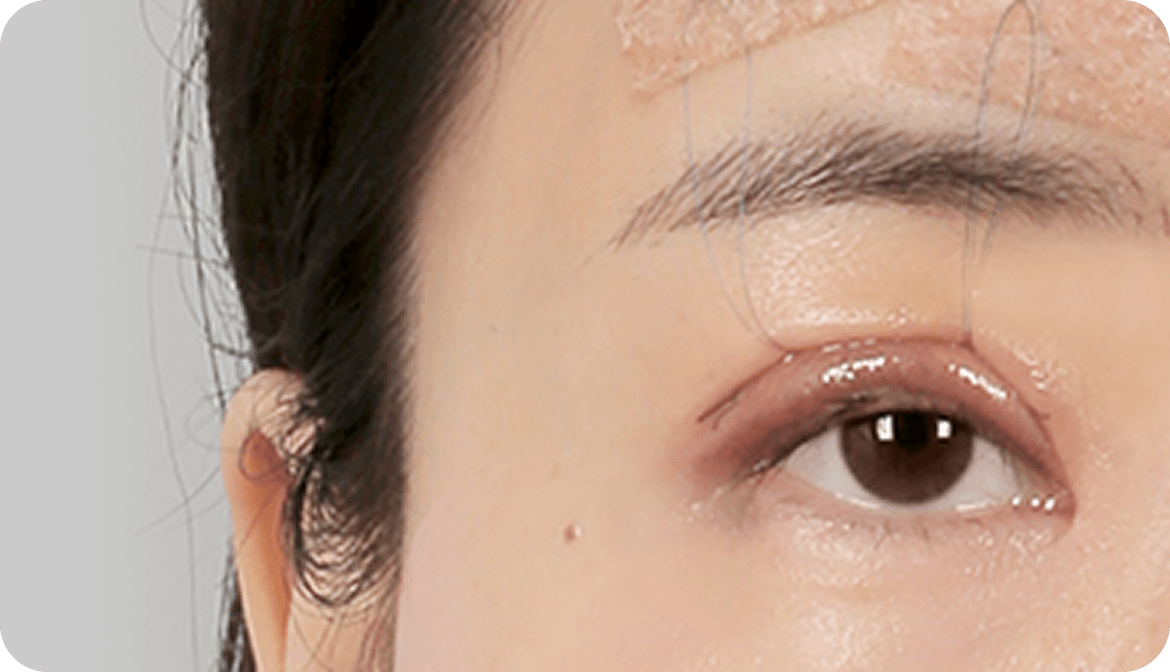 id Hospital - Middle-Age Ptosis Correction - Control Knot