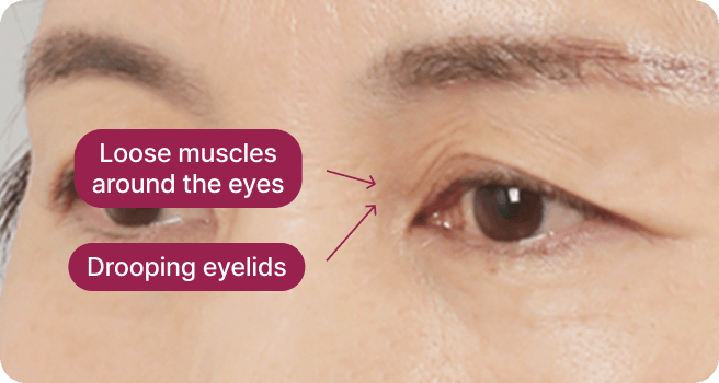 id Hospital - Upper Blepharoplasty - Eyelid Enhancement