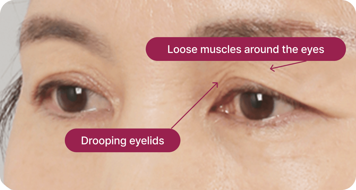 id Hospital - Upper Blepharoplasty - Eyelid Enhancement