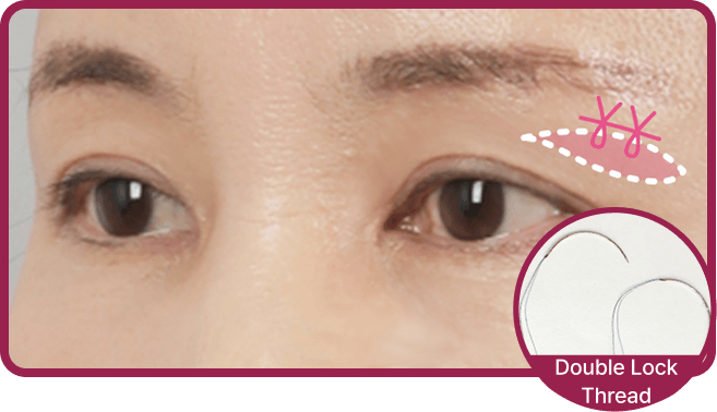 id Hospital - Upper Blepharoplasty - Double Lock Thread