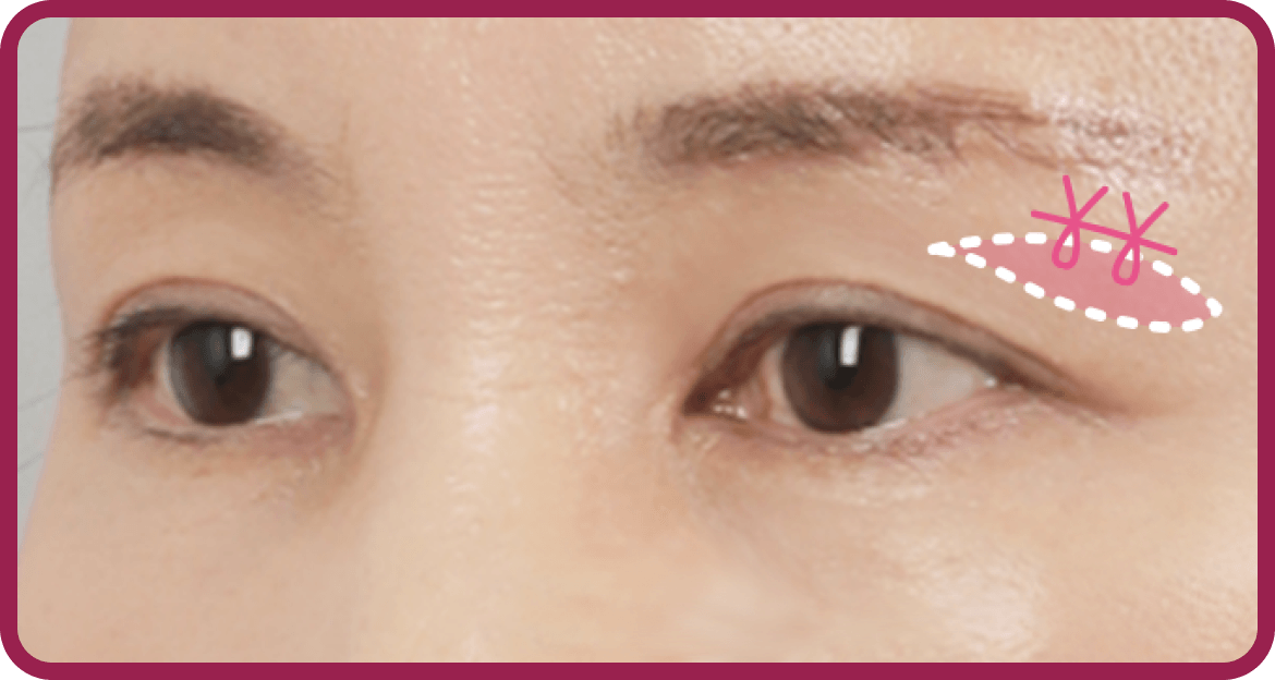 id Hospital - Upper Blepharoplasty - Double Lock Thread