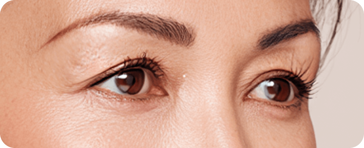 id Hospital - Upper Blepharoplasty - Before Surgery