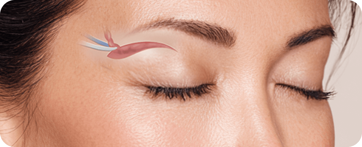id Hospital - Upper Blepharoplasty - Sagging Skin Removal