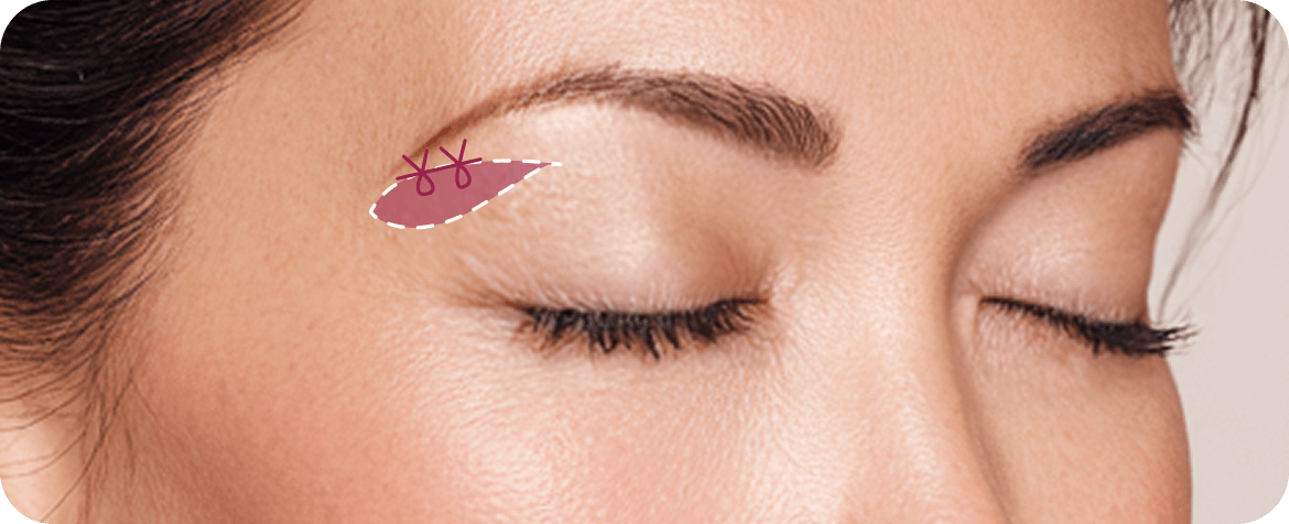 id Hospital - Upper Blepharoplasty - Eyelid Muscle Strengthening