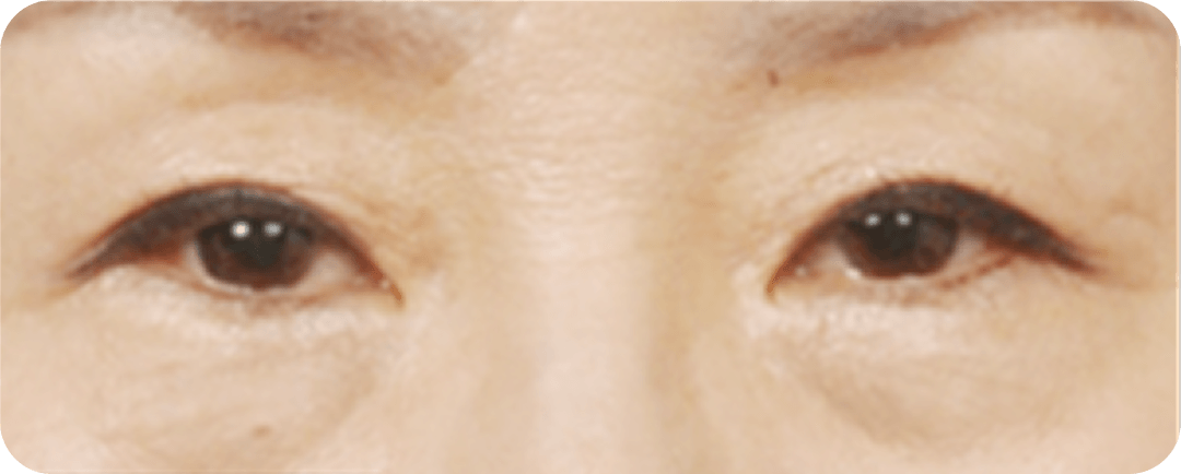 id Hospital - Middle-Age Under Eye Fat Re-positioning - Before Surgery