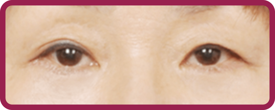 id Hospital - Middle-Age Under Eye Fat Re-positioning - After Surgery