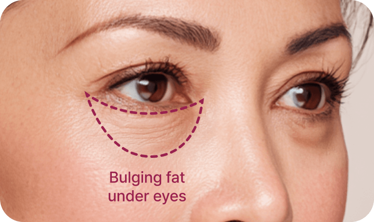 id Hospital - Middle-Age Under Eye Fat Re-positioning - Removal of Fat Under Eyes