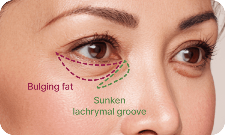 id Hospital - Middle-Age Under Eye Fat Re-positioning - Reposition of Fat Under Mid-Age Eyes