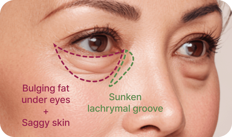id Hospital - Middle-Age Under Eye Fat Re-positioning - Lower Blepharoplasty