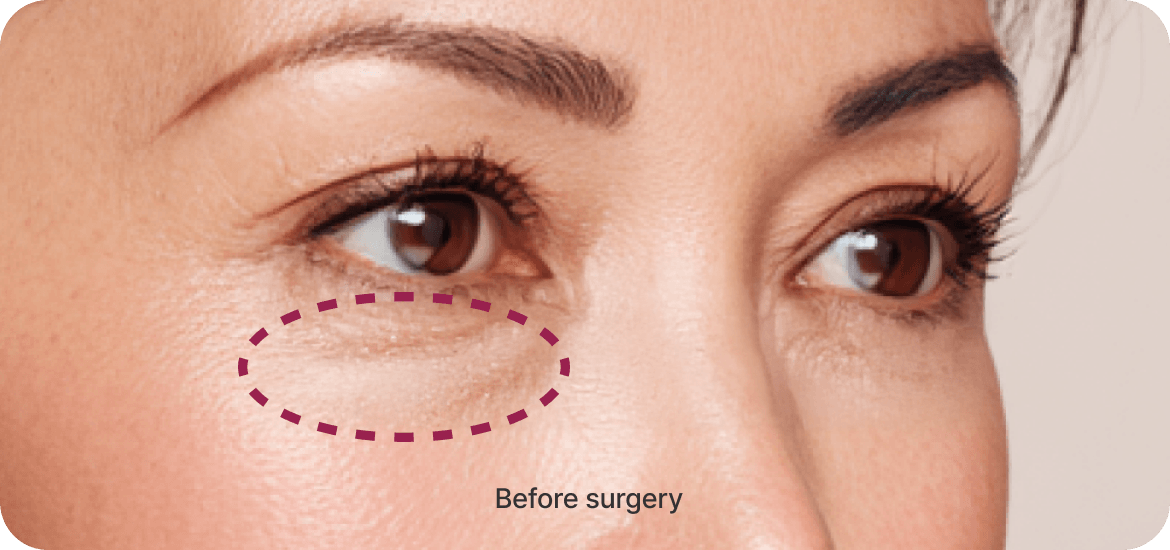 id Hospital - Middle-Age Under Eye Fat Re-positioning - Surgical Procedure Step 01