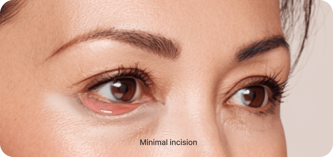 id Hospital - Middle-Age Under Eye Fat Re-positioning - Surgical Procedure Step 02