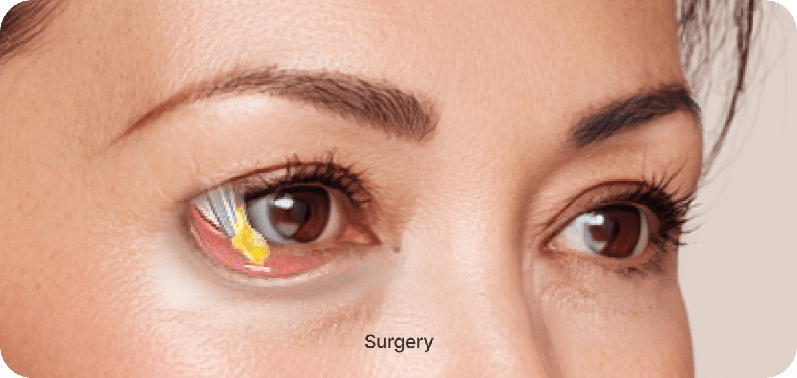 id Hospital - Middle-Age Under Eye Fat Re-positioning - Surgical Procedure Step 03