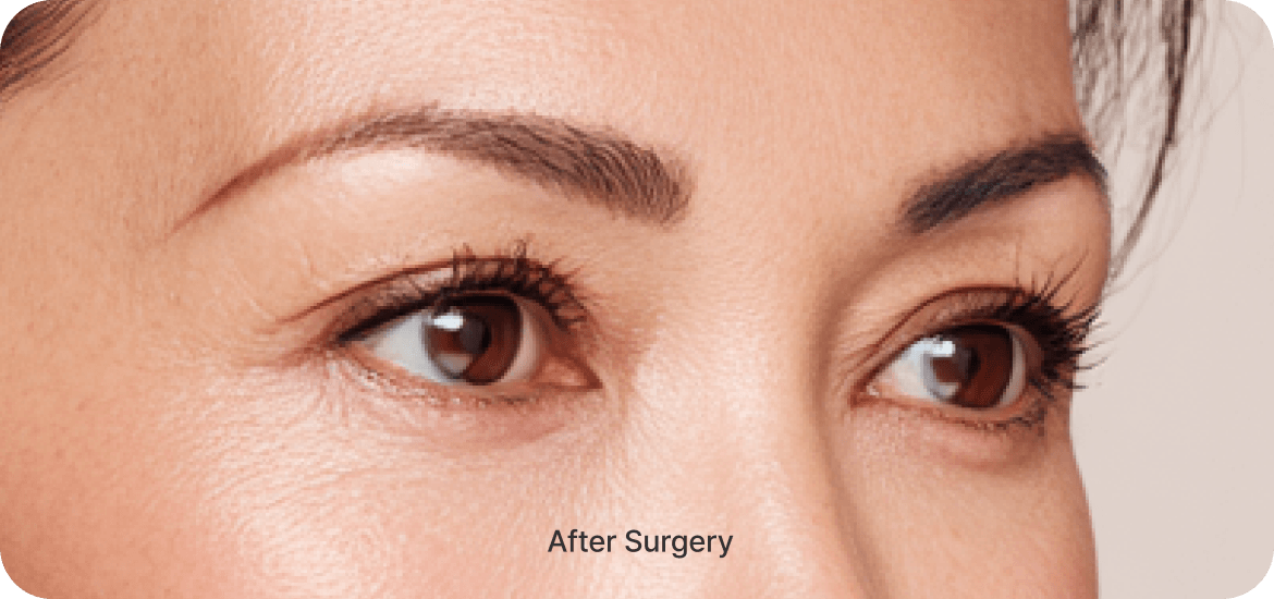 id Hospital - Middle-Age Under Eye Fat Re-positioning - Surgical Procedure Step 04